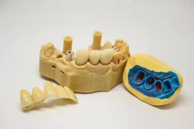 What Dentures Types are Suitable for Me in 2024?Illustration