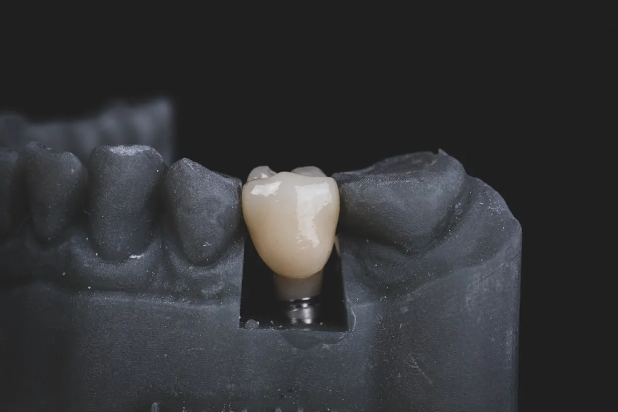 Dental ImplantsIllustration