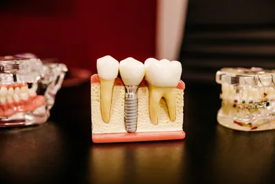 The Benefits of Dental Implants Over Traditional DenturesIllustration