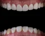 Are You a Candidate for Dental Implants? Photo