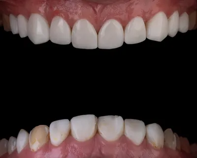 Are You a Candidate for Dental Implants?Illustration